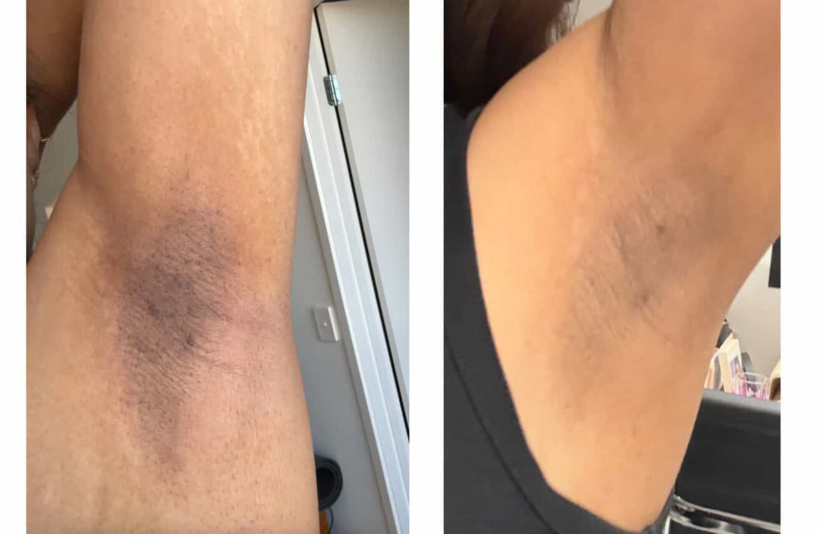 Customer photos of dark underarms before and after using Éclair