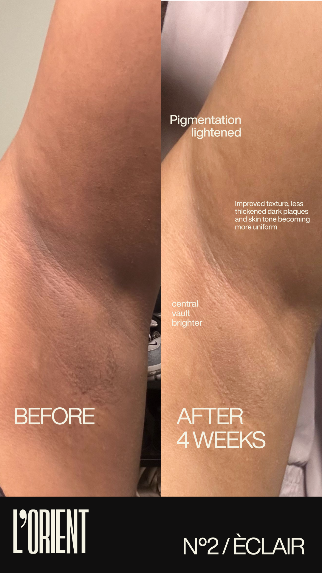 Before and after: underarm pigmentation lightened after 4 weeks of Éclair