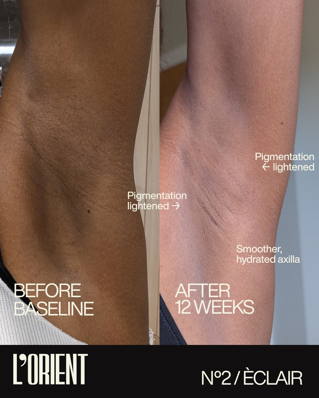 Before and after: underarm pigmentation lightened and skin smoother after 12 weeks of Éclair