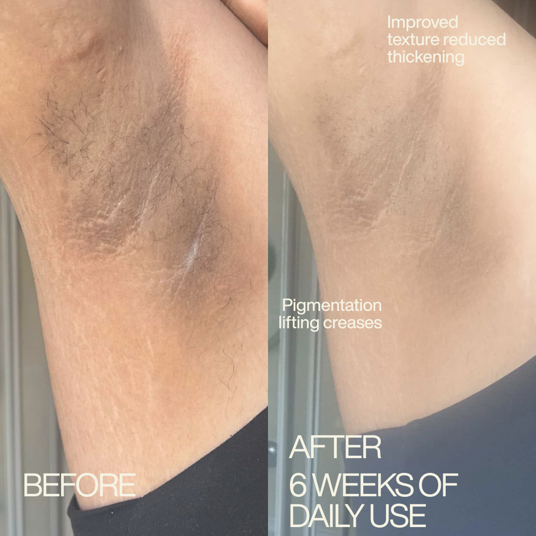 Before and after: underarm pigmentation lifted after 6 weeks of daily Éclair use